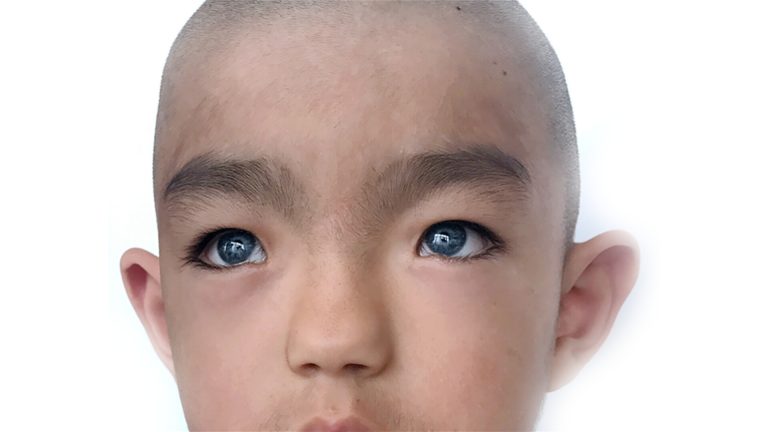 سندرم واردنبرگ (Waardenburg Syndrome)