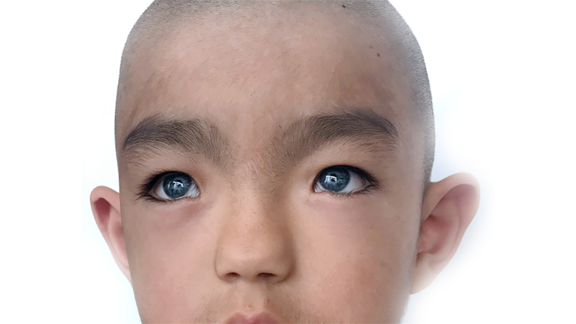 سندرم واردنبرگ (Waardenburg Syndrome)