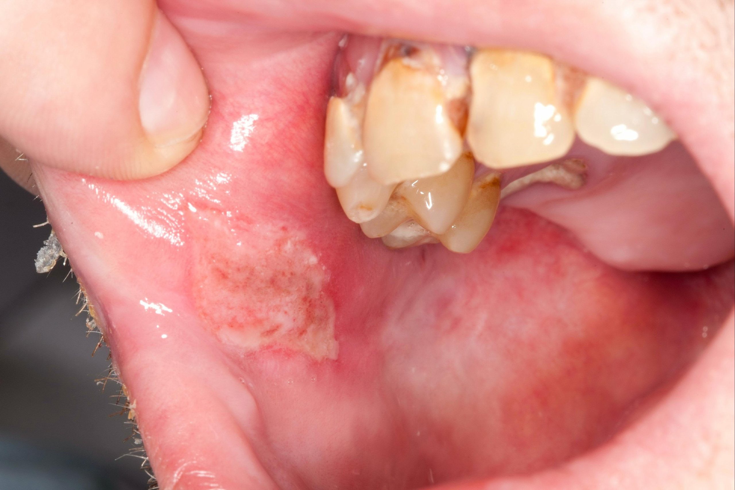 بیماری بهجت (Behçet’s Disease)