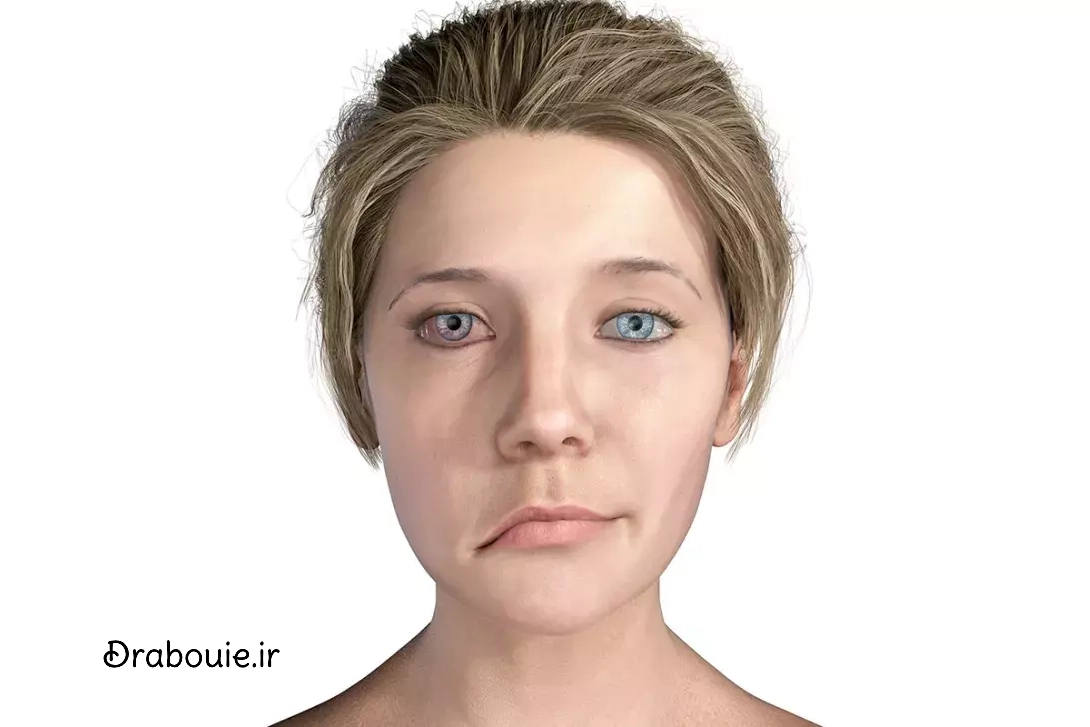 فلج بل (Bell’s Palsy) و ارتباطش با پریدن در آب سرد