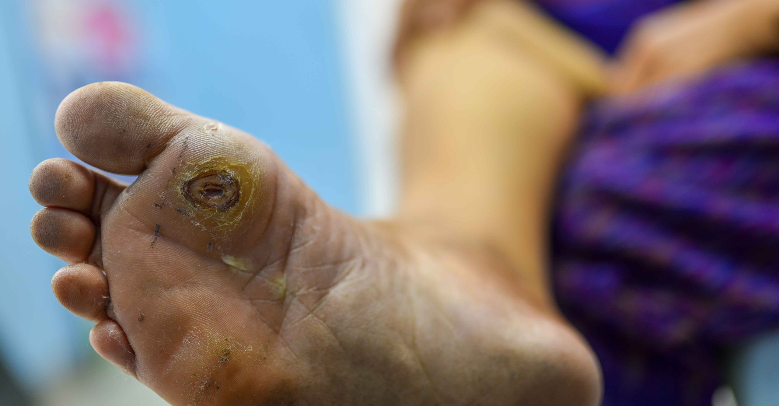 زخم پای دیابتی