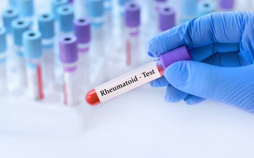 روماتوئید فاکتور Rheumatoid Factor