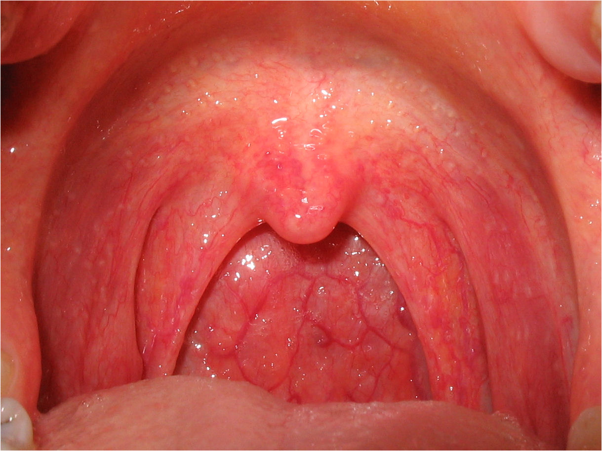 تشخیص افتراقی‌های فارنژیت (Differential Diagnosis of Pharyngitis)